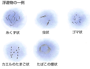 飛蚊症