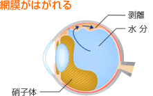 網膜がはがれる