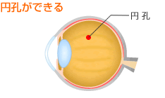円孔ができる