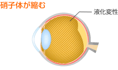 硝子体が縮む