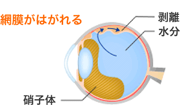 網膜がはがれる