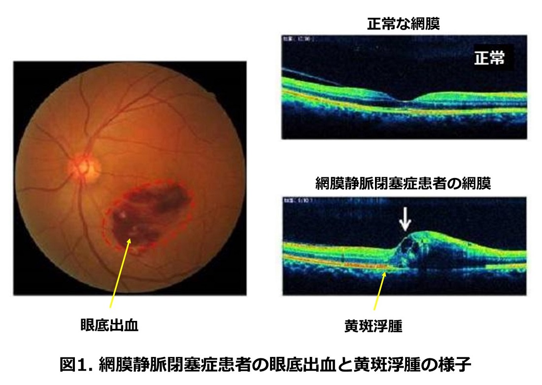 網膜静脈閉塞症眼底出血と黄斑浮腫の様子