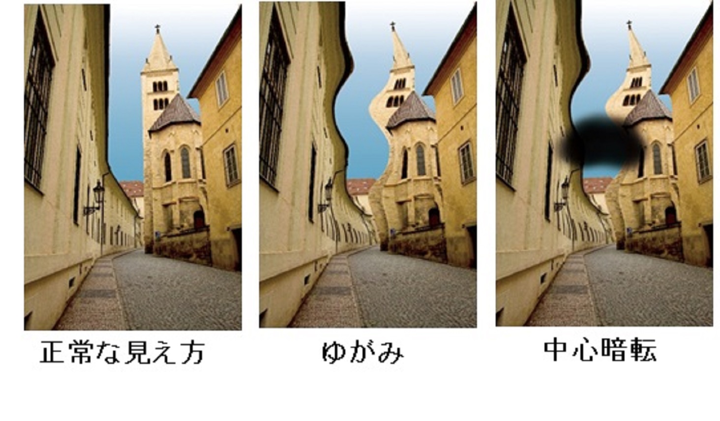 ゆがんで見える」「見たいところが見えない」加齢黄斑変性はセルフチェックで早期発見を！ | メノコト byわかさ生活