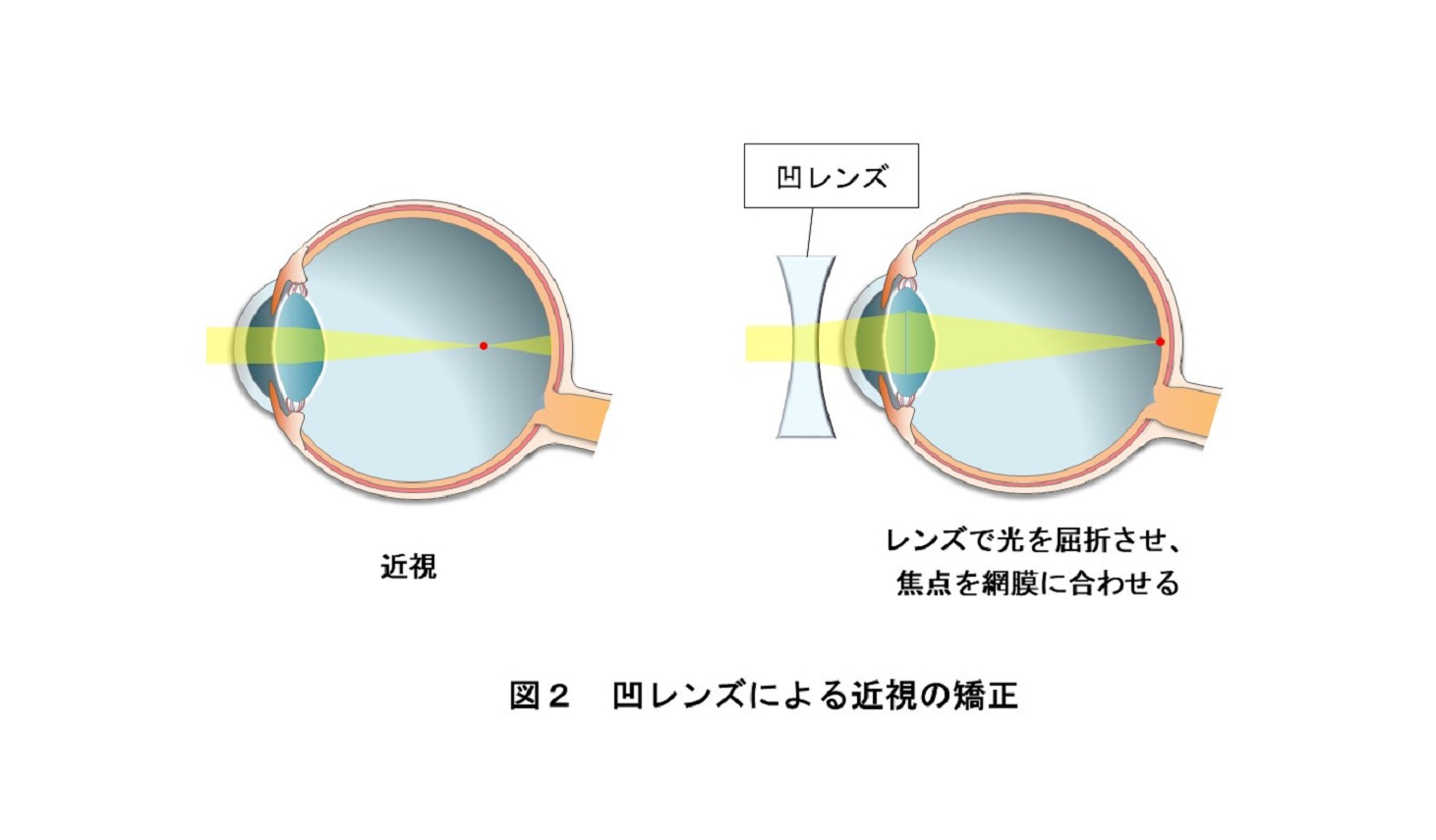 凹レンズによる近視の矯正