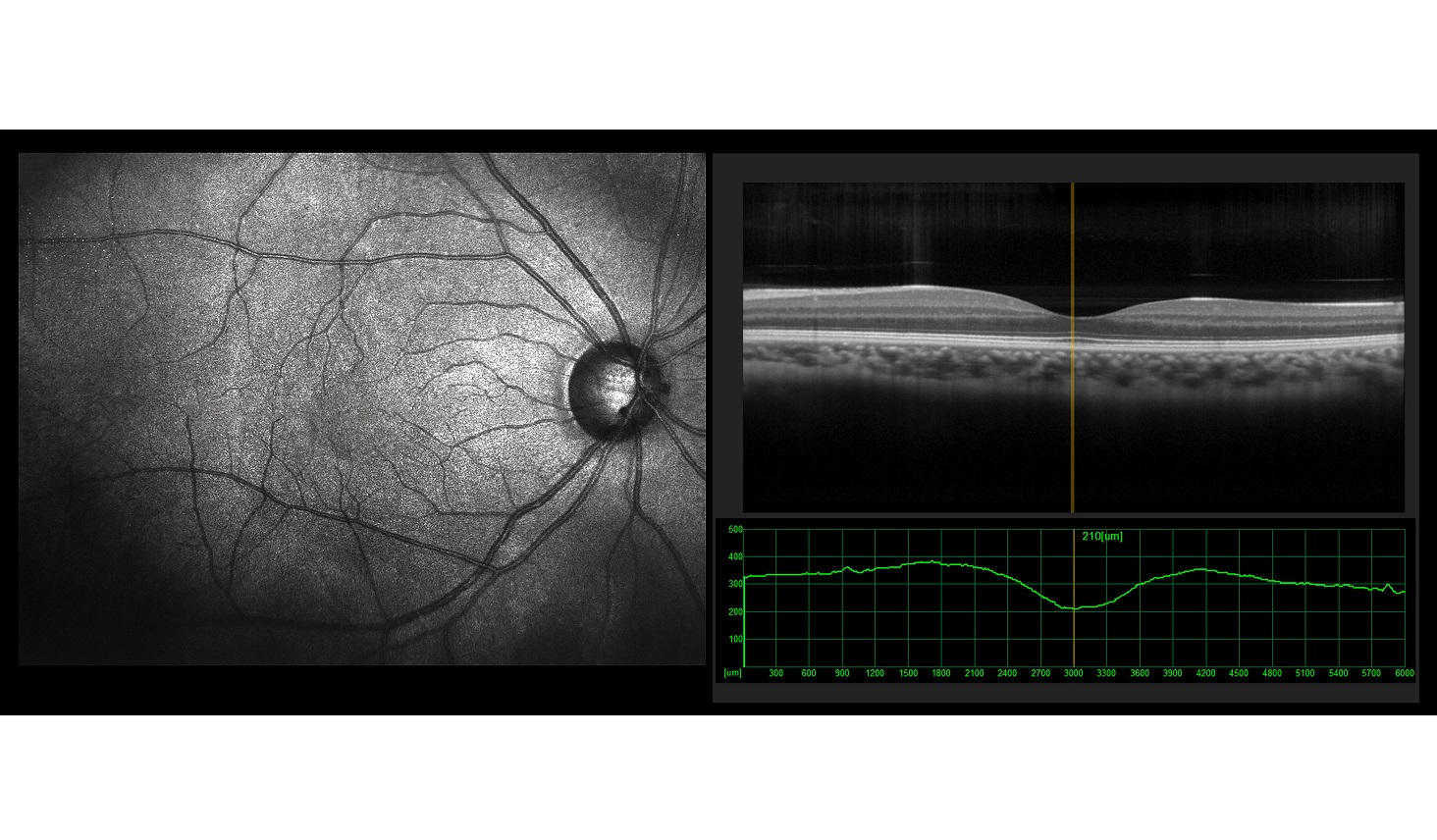 OCTによる網膜の撮影（イメージ）