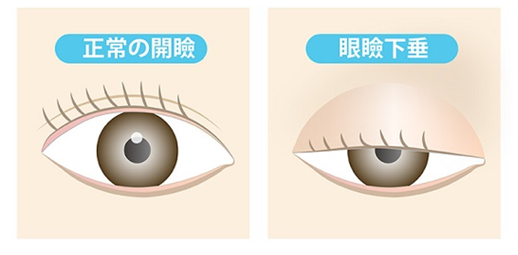 眼瞼下垂の症状イラスト