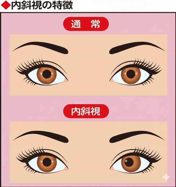 斜視をイラストにしたAI画像